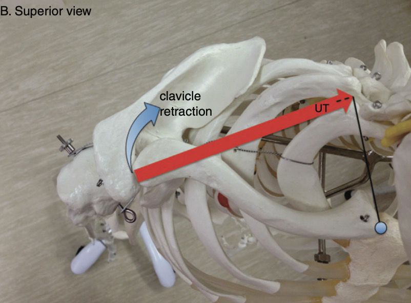 上部僧帽筋による鎖骨の挙上と後退作用を示す生体力学モデル図
